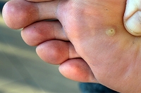 Causes of Plantar Warts and How They Are Treated