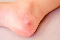 Causes of Blisters on the Feet