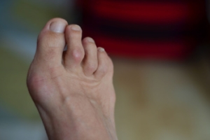 Characteristics of Hammertoe