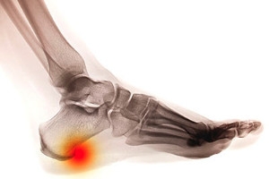 Possible Causes and Symptoms of Heel Spurs