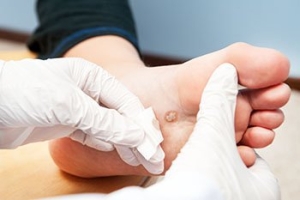 How Do Plantar Warts Form?