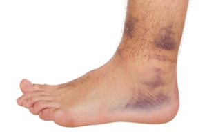 Causes and Recovery From Ankle Sprains in Athletes
