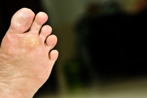 Preventing Plantar Warts