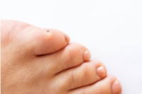 Causes and Treatment of Corns