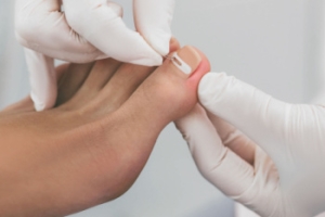 Causes and Types of Ingrown Toenails