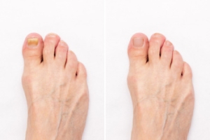 Toenail Fungus Progression and Treatment