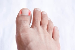 Managing Infected Ingrown Toenails