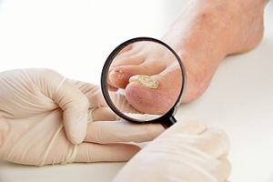 How Toenail Fungus May Be Treated