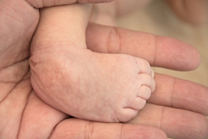 Clubfoot and the Role of a Podiatrist