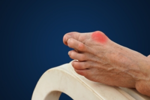 Understanding Bunions and How to Treat Them