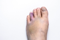 What Happens When You Break a Toe?