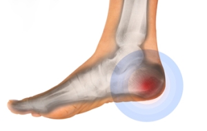 When Heel Pain Comes From a Trapped Nerve
