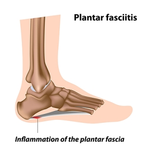 Treatments for Plantar Fasciitis
