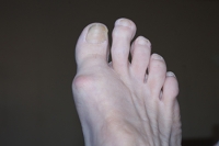 Understanding Morton's Toe