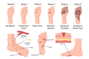 Early Intervention for Diabetic Foot Ulcers