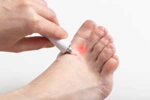 Symptoms and Risk Factors for Athlete’s Foot