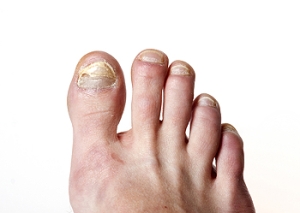 Risk Factors for Toenail Fungus