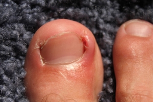 Common Symptoms of an Ingrown Toenail