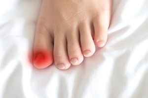 Managing Ingrown Toenails