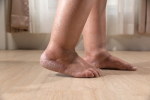 Recognizing When Swelling in Your Feet and Ankles Is Serious