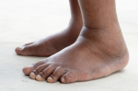 Reasons Your Ankle Is Swollen