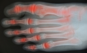 Types of Arthritis That Can Affect Your Feet