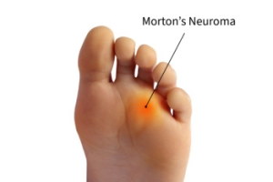 Relieving Pain From Morton’s Neuroma for Improved Foot Comfort