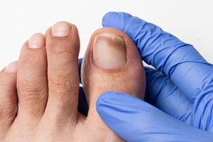 How Diabetes Affects Toenails