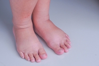 Swollen Feet During Pregnancy